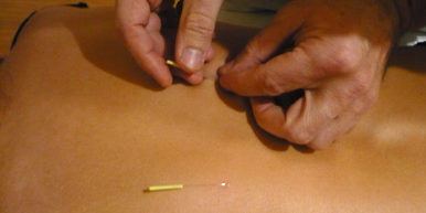 Mónico Sánchez aplica agujas muy finas.