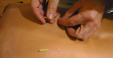 Mónico Sánchez aplica agujas muy finas.